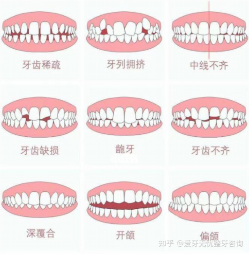 矫正牙上鄂安了一个东西是什么,矫正牙齿在上颚装的一个白色硬物是什么(图1)